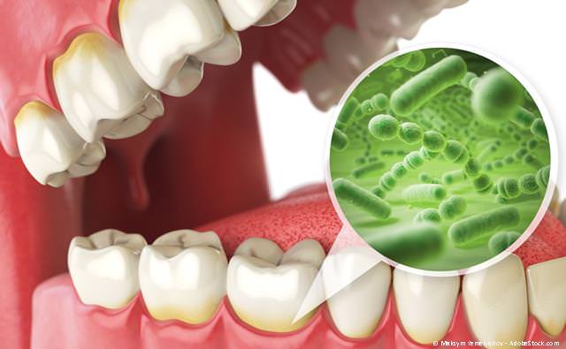 Parodontosebehandlung bei Zahnfleischbluten und Zahnlockerungen